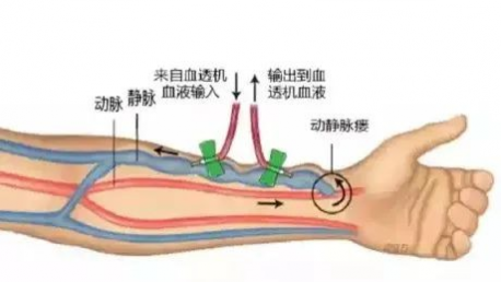 疏通血液透析患者“生命线”——靖西市人民医院肾内科为多名患者成功实施动静脉内瘘球囊扩张术 - 靖西网