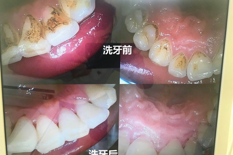 【免费洗牙】好消息 靖西佳利口腔一周年庆典，感恩回馈为广大市民提供免费洁牙体验，名额有限先到先得！ - 靖西市·靖西网