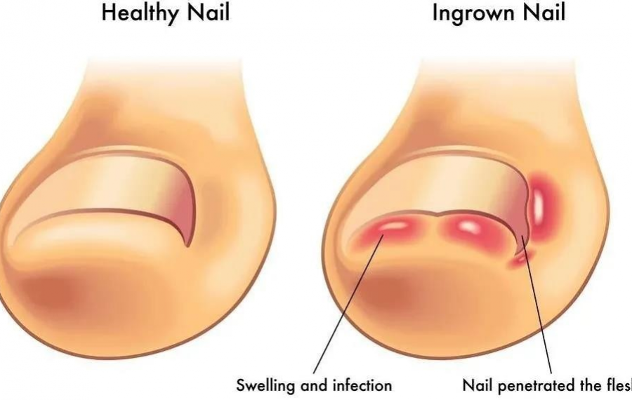 趾甲老往肉里长、一碰就痛，怎么办？ - 靖西市·靖西网