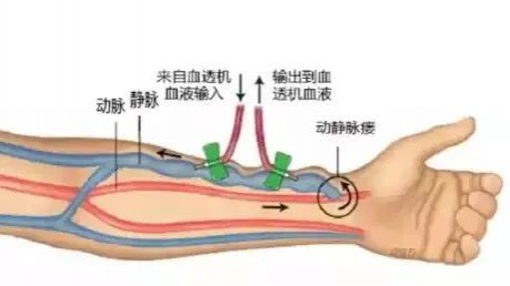 疏通血液透析患者“生命线”——靖西市人民医院肾内科为多名患者成功实施动静脉内瘘球囊扩张术 - 靖西市·靖西网